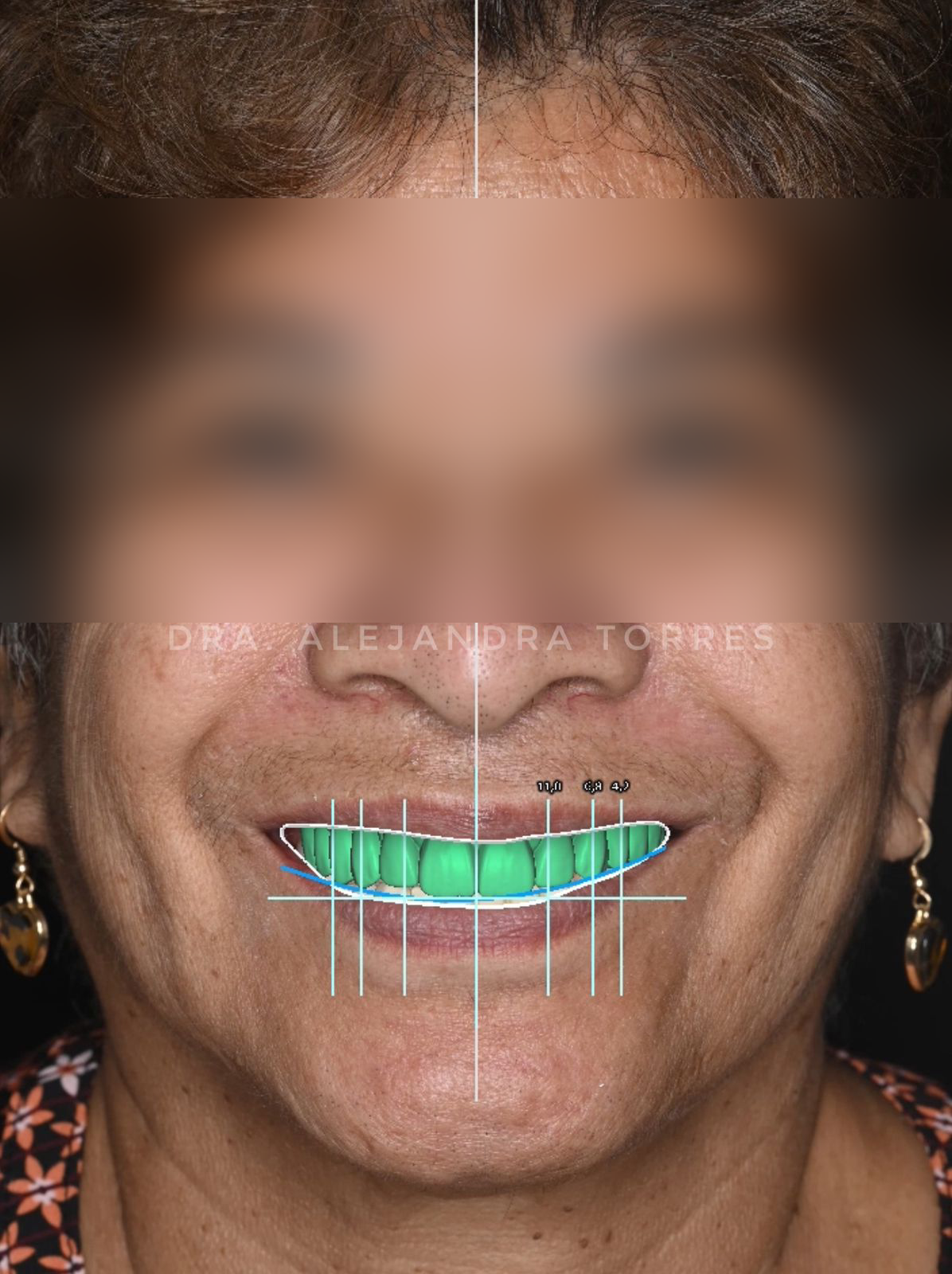 Prótesis sobre implantes